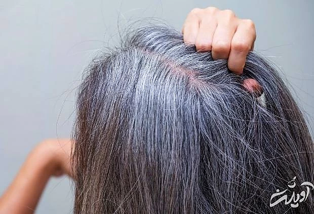 تاثیر استرس بر سفیدی مو علت سفیدی ناگهانی مو